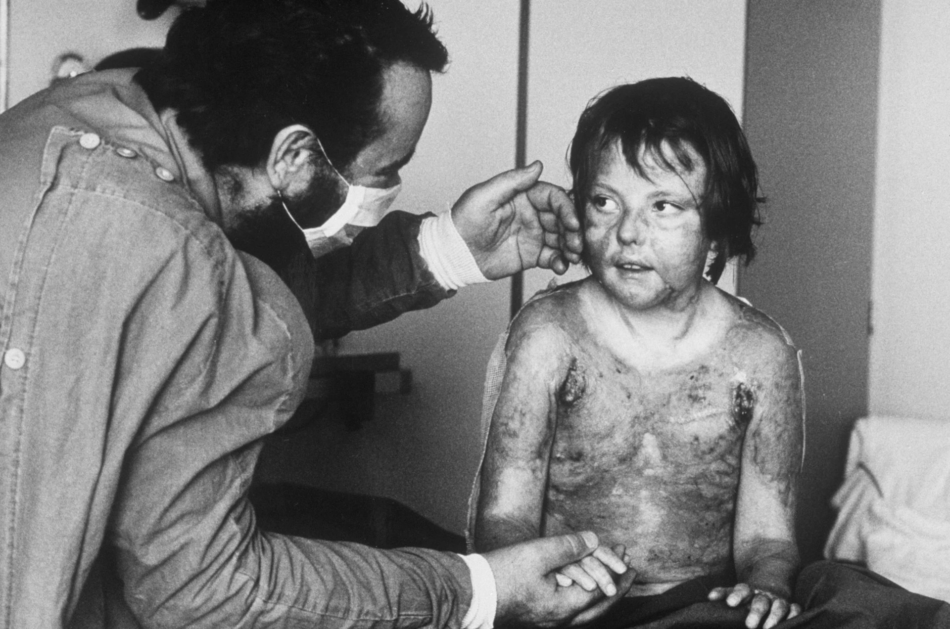 Foto in bianco e nero di un medico con la mascherina che accarezza la guancia di una bambina con ampie lesioni da ustione e le tiene la mano.
